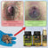 Before-and-after style hemorrhoid review graphic with Piles Matrix bottles, capsules, and gel.