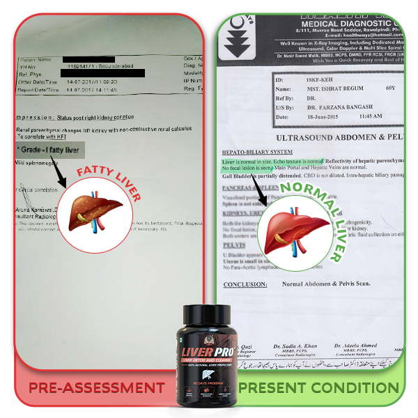 YogaManLab® Liver Pro - Fatty Liver Ayurvedic Supplement | Helps Restore Liver Health & Remove Toxins | 100% Natural & Ayurvedic | 28 Days Program