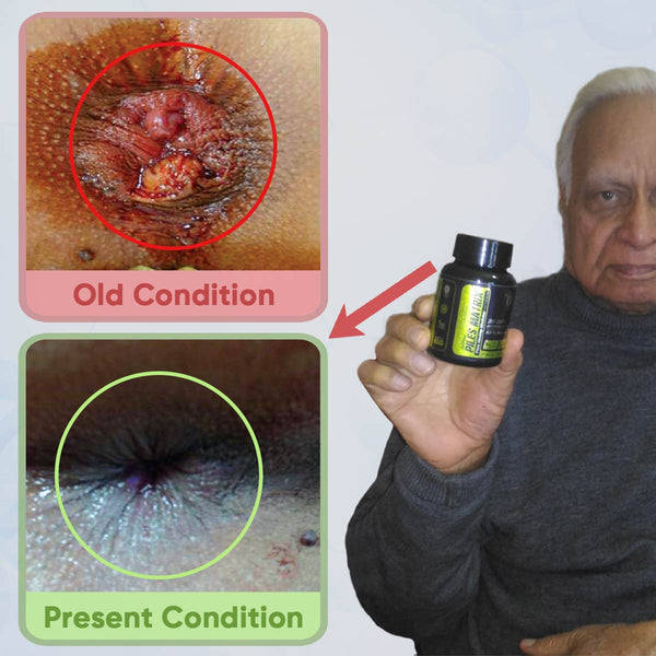 YogaManLab® PILES MATRIX - Piles Treatment Ayurvedic Capsules & Lepam Ointment | With Free Diet & Doctor | Treats Internal Grade1-4 & External Hemorrhoids | 100% Natural