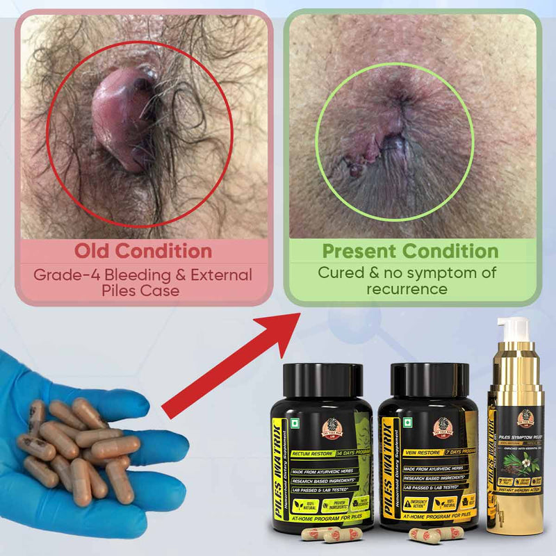 Before-and-after style hemorrhoid review graphic with Piles Matrix bottles, capsules, and gel.