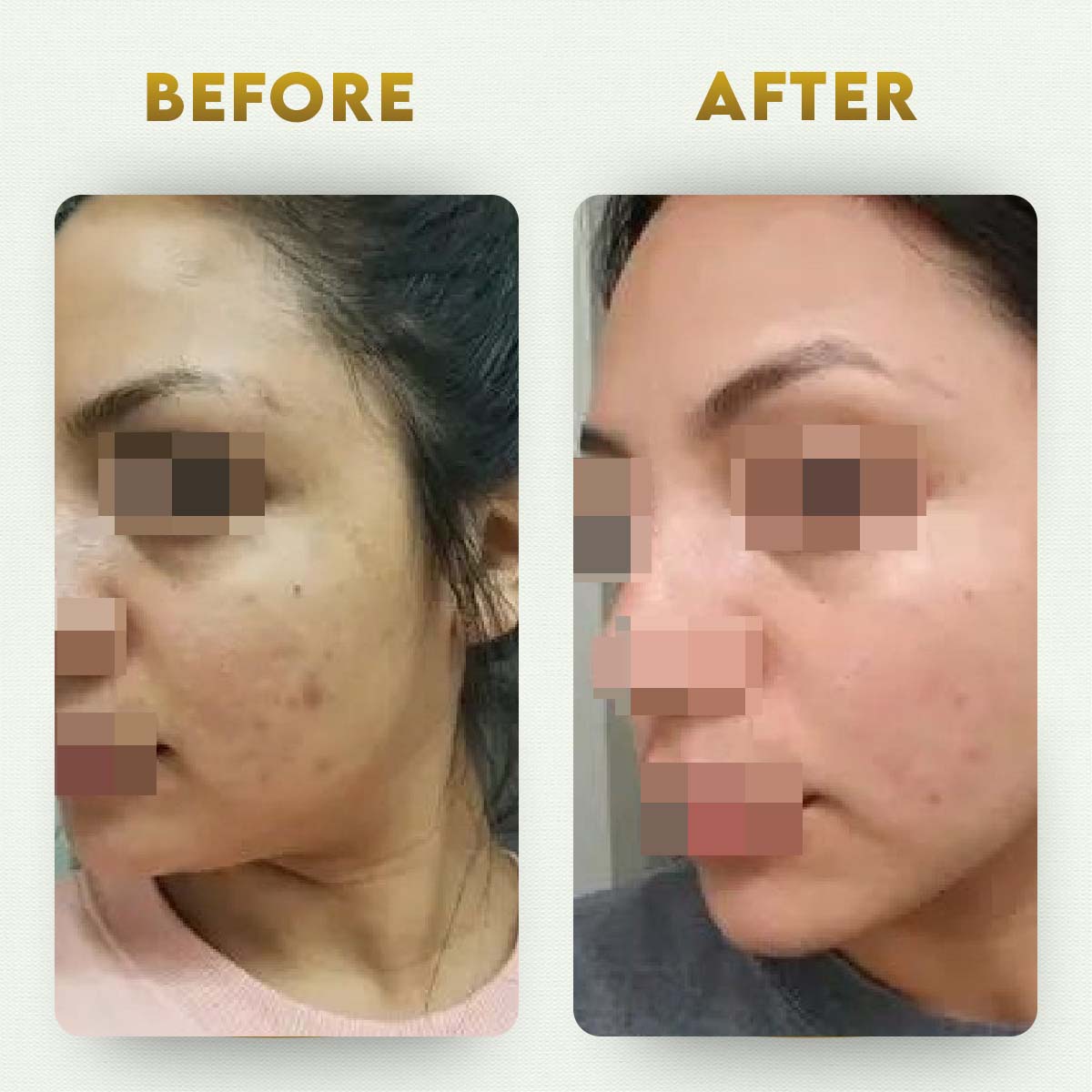 glutathione before and after men of an indian doctor who got gluta IV. Notice it's very subtle change but effective : r/skinwhitening Examining Glutathione Injection Skin Whitening: